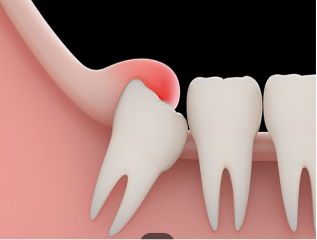 دندان نهفته و درمان آن 